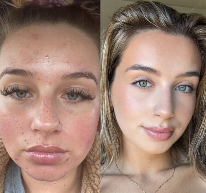Skin transformation from improving lifestyle habits — no SPF, stress, sleeping in makeup, bad advice, picking skin, dirty pillowcases, poor diet. Results from skincare and water only, no filler or Botox.